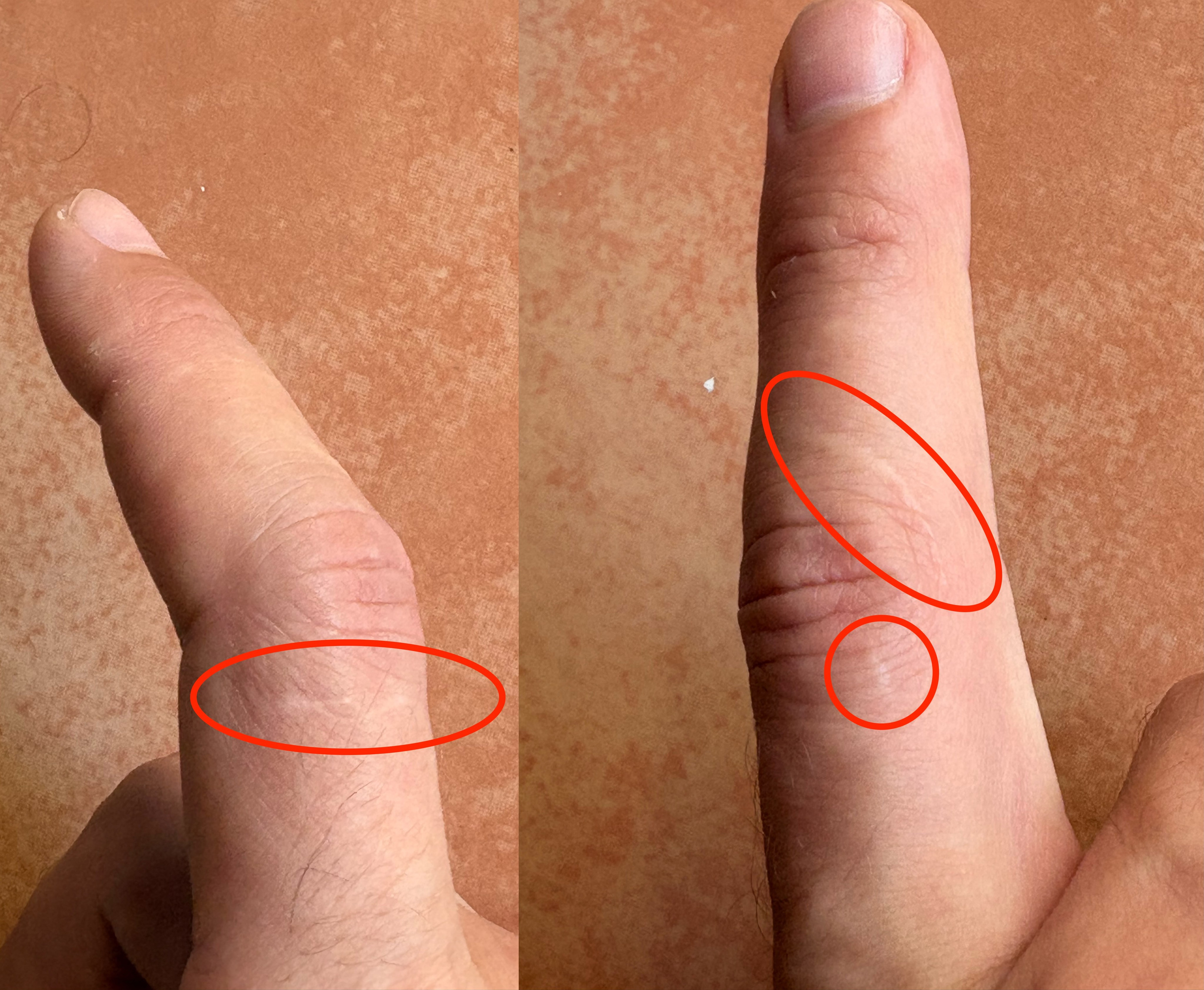 Scars on a finger after a moray eel bite in the Dominican Republic